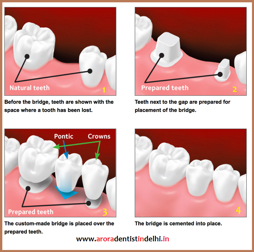 Best Prosthodontist in Delhi